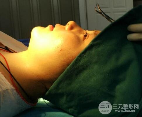 隆鼻整形包括假体隆鼻+耳软骨垫鼻尖+鼻小柱延长