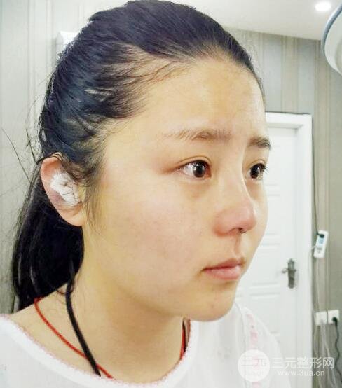 隆鼻整形包括假体隆鼻+耳软骨垫鼻尖+鼻小柱延长