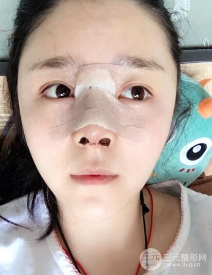 隆鼻整形包括假体隆鼻+耳软骨垫鼻尖+鼻小柱延长