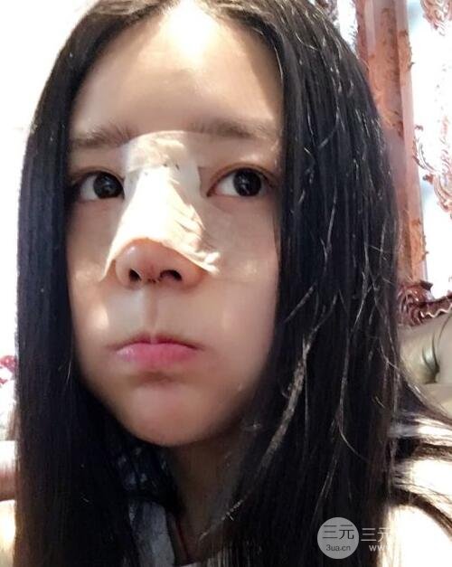 隆鼻整形包括假体隆鼻+耳软骨垫鼻尖+鼻小柱延长