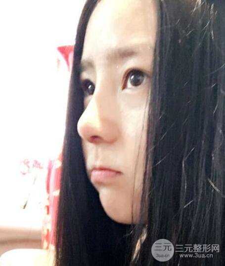 隆鼻整形包括假体隆鼻+耳软骨垫鼻尖+鼻小柱延长