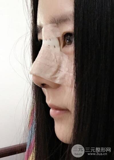 隆鼻整形包括假体隆鼻+耳软骨垫鼻尖+鼻小柱延长