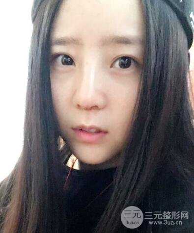 隆鼻整形包括假体隆鼻+耳软骨垫鼻尖+鼻小柱延长