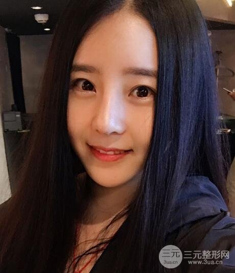 隆鼻整形包括假体隆鼻+耳软骨垫鼻尖+鼻小柱延长