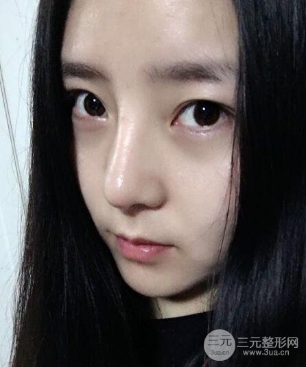 隆鼻整形包括假体隆鼻+耳软骨垫鼻尖+鼻小柱延长