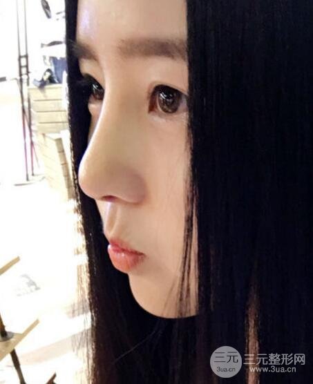 隆鼻整形包括假体隆鼻+耳软骨垫鼻尖+鼻小柱延长