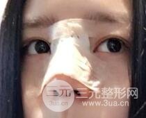 隆鼻整形包括假体隆鼻+耳软骨垫鼻尖+鼻小柱延长