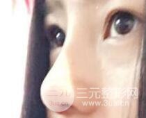 隆鼻整形包括假体隆鼻+耳软骨垫鼻尖+鼻小柱延长