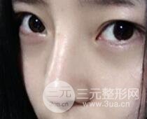 隆鼻整形包括假体隆鼻+耳软骨垫鼻尖+鼻小柱延长