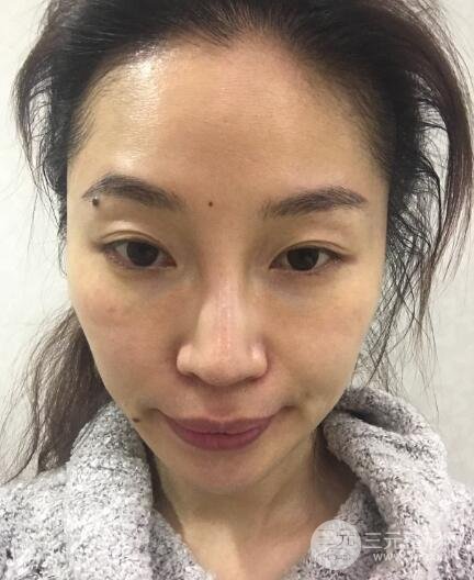 面b提升术多少钱?价格和案例分享