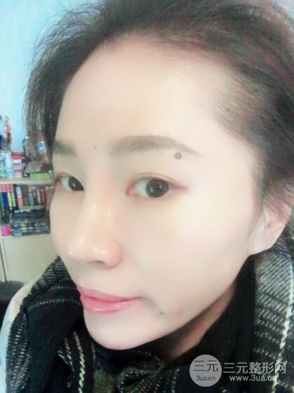 面b提升术多少钱?价格和案例分享