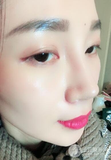 面b提升术多少钱?价格和案例分享