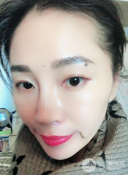 面b提升术多少钱?价格和案例分享