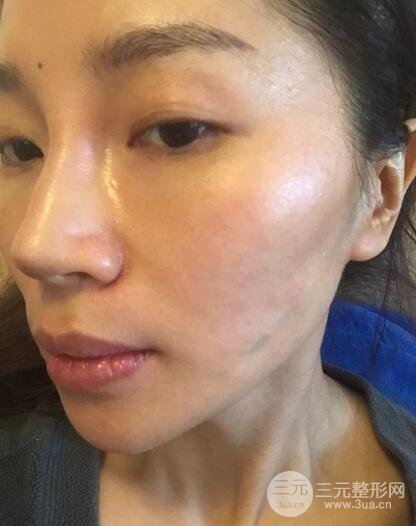 面b提升术多少钱?价格和案例分享