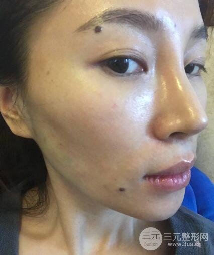 面b提升术多少钱?价格和案例分享