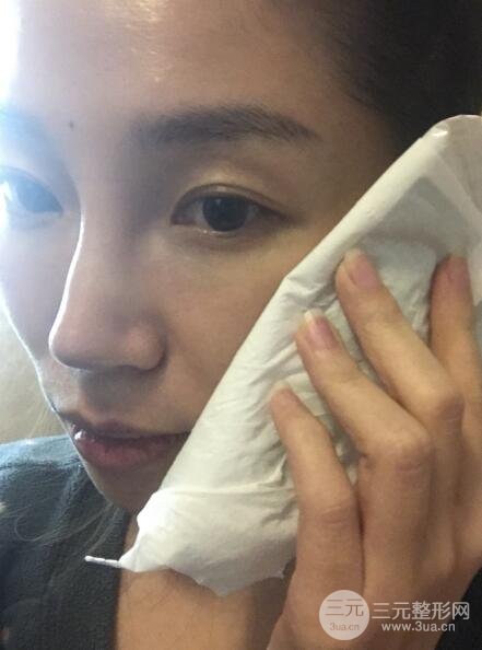 面b提升术多少钱?价格和案例分享