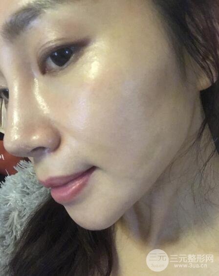 面b提升术多少钱?价格和案例分享