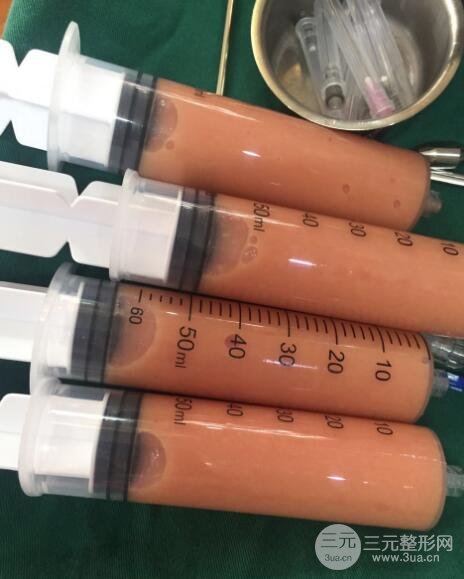 自体脂肪面部填充价位和案例