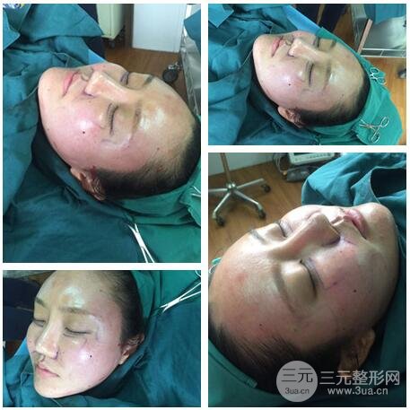 自体脂肪面部填充价位和案例