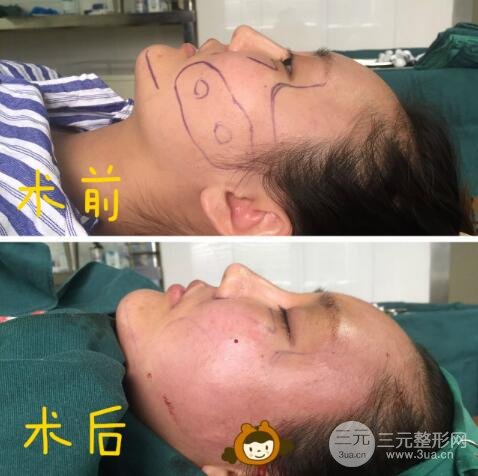 自体脂肪面部填充价位和案例