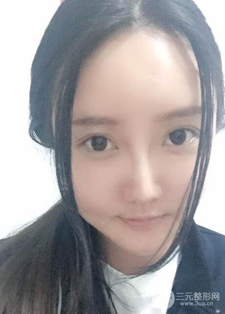 自体脂肪面部填充价位和案例