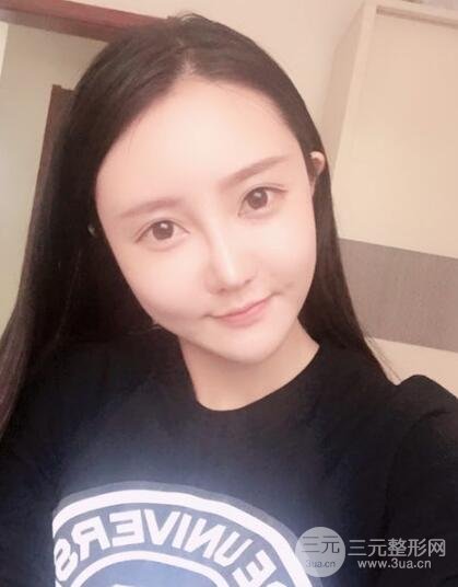 自体脂肪面部填充价位和案例