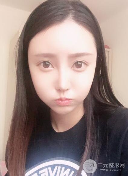 自体脂肪面部填充价位和案例