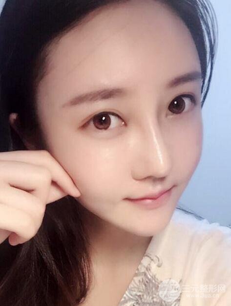 自体脂肪面部填充价位和案例