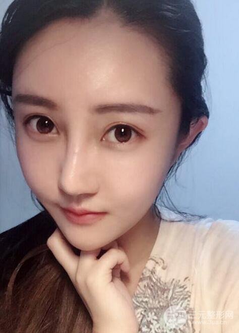 自体脂肪面部填充价位和案例