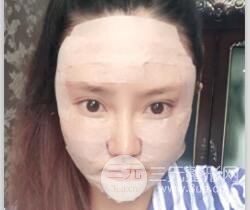 自体脂肪面部填充价位和案例