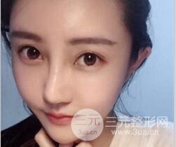 自体脂肪面部填充价位和案例