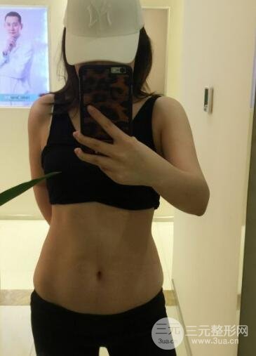 腹部抽脂价格和恢复案例