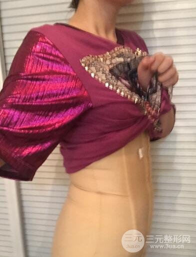 腹部抽脂价格和恢复案例