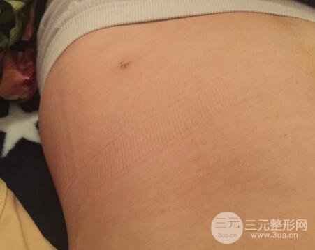 腹部抽脂价格和恢复案例