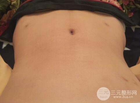 腹部抽脂价格和恢复案例