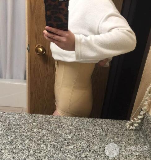 腹部抽脂价格和恢复案例