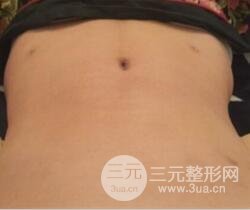 腹部抽脂价格和恢复案例