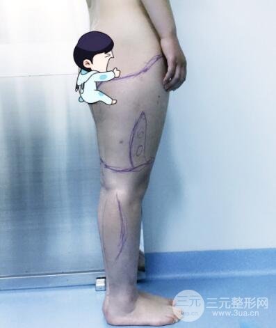 抽脂瘦腿价格和亲身经历图