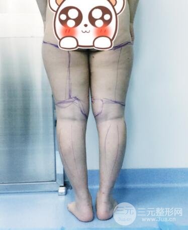 抽脂瘦腿价格和亲身经历图