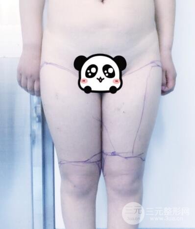 抽脂瘦腿价格和亲身经历图