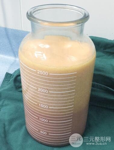 抽脂瘦腿价格和亲身经历图