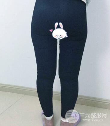 抽脂瘦腿价格和亲身经历图