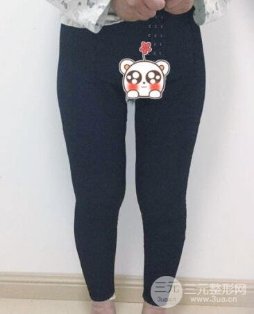 抽脂瘦腿价格和亲身经历图