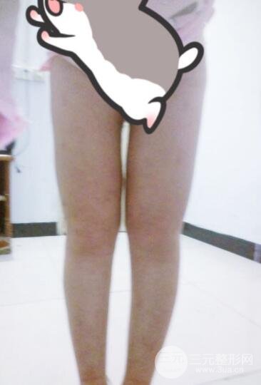 抽脂瘦腿价格和亲身经历图