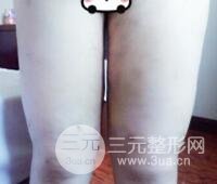 抽脂瘦腿价格和亲身经历图