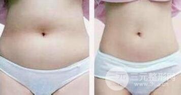 有的懒人减肥法是吸脂减肥【价格】
