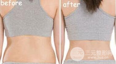 有的懒人减肥法是吸脂减肥【价格】