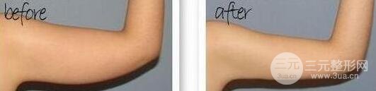 有的懒人减肥法是吸脂减肥【价格】