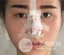 鼻子整形恢复过程真人案例