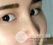 鼻子整形恢复过程真人案例